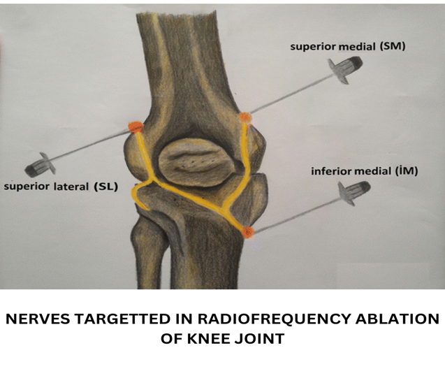 Best-Pain-Management-in-India-by-Dr-Dhurv-Sharma