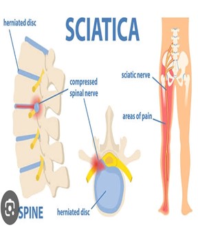 slipped-disc-treatment-in-delhi-faridabad-india-dr-dhruv-sharma