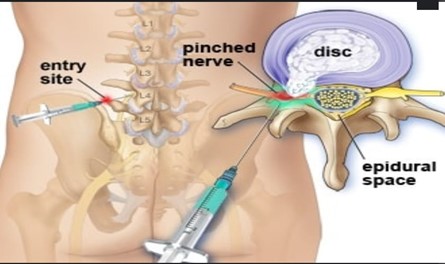 slipped-disc-treatment-in-delhi-faridabad-india-dr-dhruv-sharma