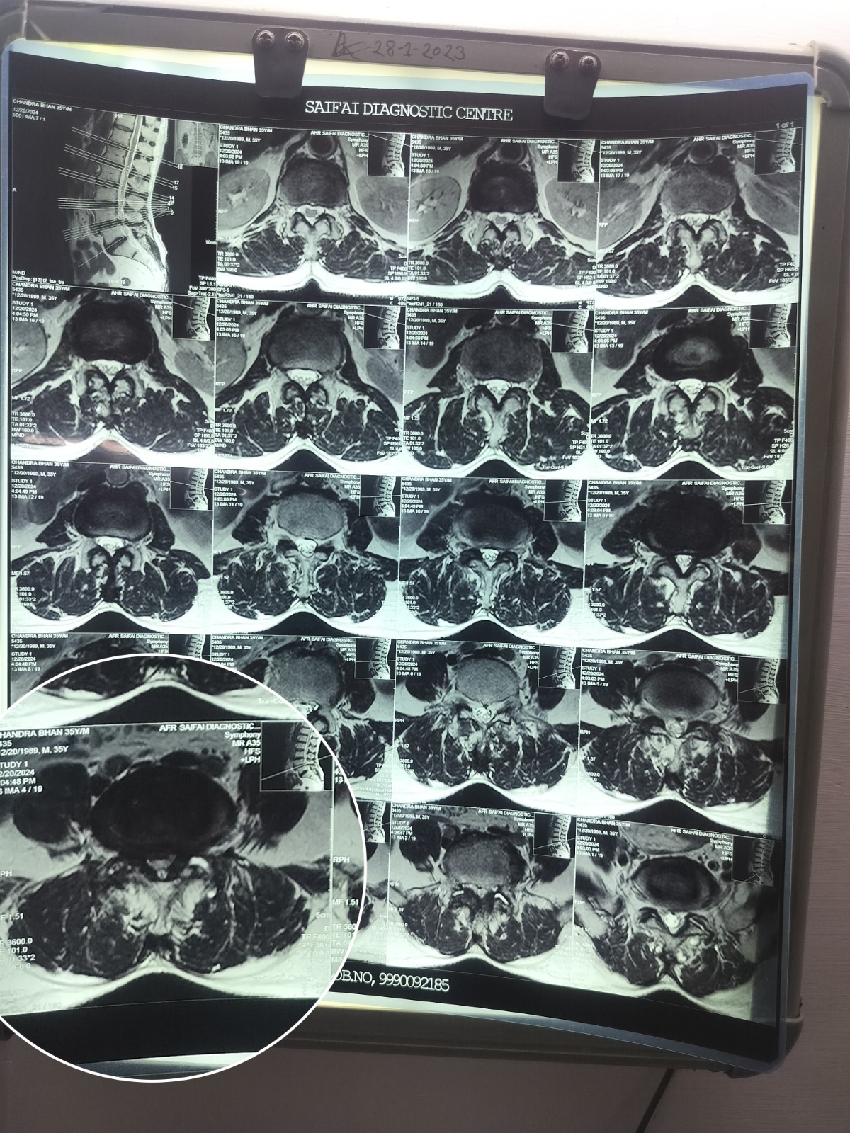 spine-stenosis-mri-x-ray-scan-dr-dhruv-sharma